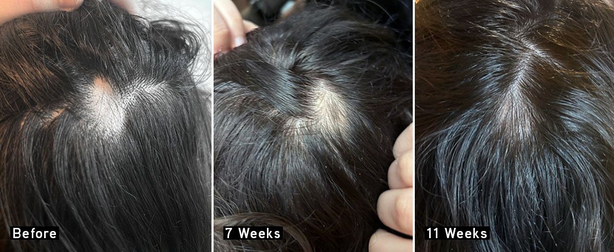 Before and after hair growth treatment showing progress over 11 weeks.